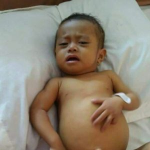 Bayi 8 Bulan Mengidap Atresia Billier