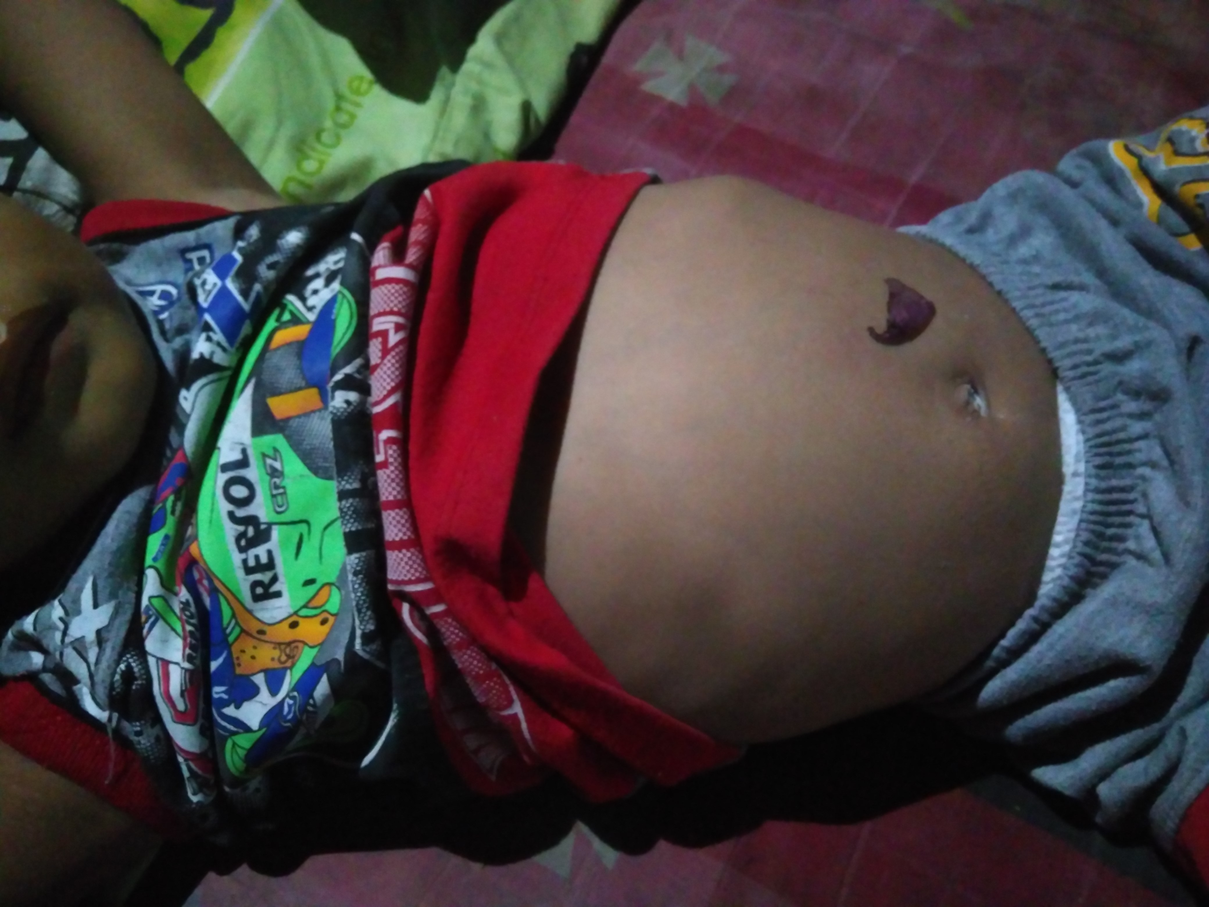 Penyebab Perut Kembung Pada Anak Dan Mengatasinya